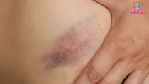 why do blue bruises appear on the body without any injury & when are they a warning sign