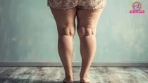 lipedema can cause thick thighs its causes symptoms & treatment