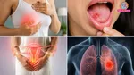 early signs of the four most common cancers in india