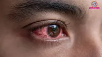 eye infections in monsoon causes symptoms prevention & treatment
