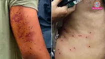 how serious can pellet gun injuries be sehat