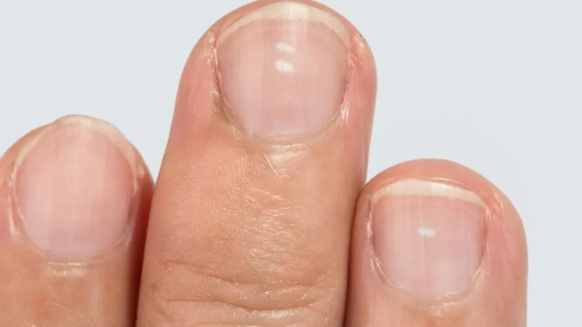 Discoloured or YELLOW nails could be a symptom of a fungal infection |  Express.co.uk