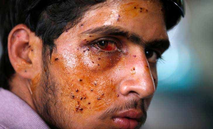 ATTENTION EDITORS - VISUAL COVERAGE OF SCENES OF INJURY OR DEATH A man who got injured in the clashes between Indian police and protesters, sits inside a hospital, in Srinagar, July 14, 2016. REUTERS/Danish Ismail