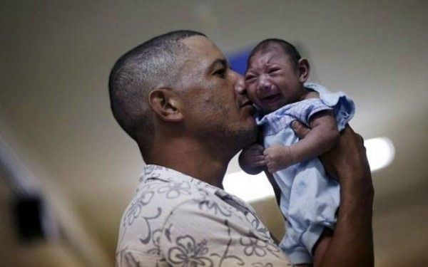 माइक्रोसिफैली से पीड़ित एक बच्चा