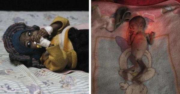 Malnutrition in india