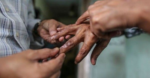 भारत में कुष्ठ रोग इलाज की पुख्ता व्यवस्था है और जल्दी बीमारी का पता चलने से मरीज विकलांगता से भी बच रहे हैं.