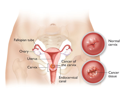 cervical
