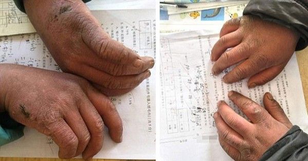 वांग के ठंड की वजह से सूजे हुए हाथ