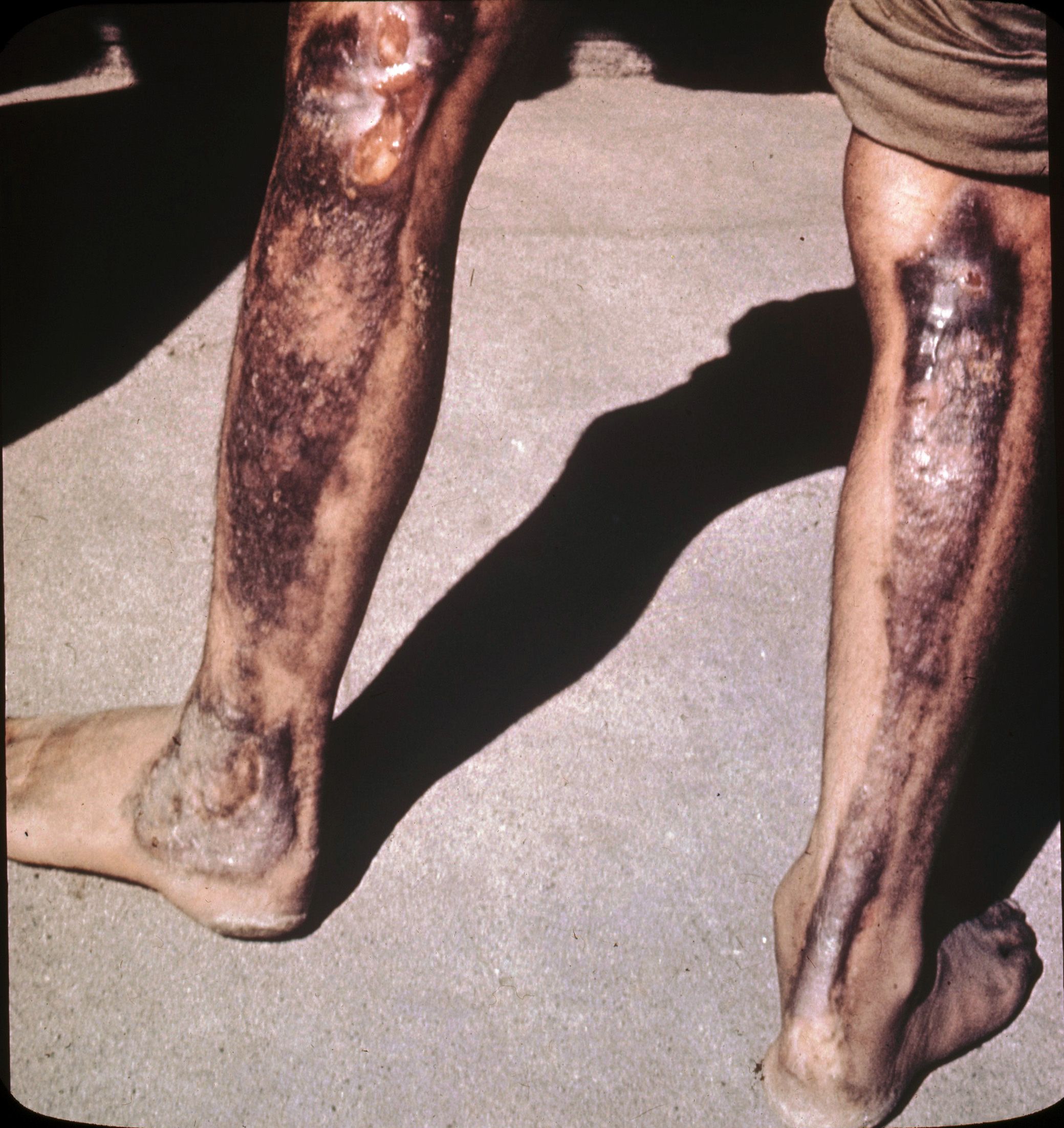 परमाणु बम से निकली गर्मी दूर खड़े लोगों को भी इस तरह झुलसा देती है. (फोटोःविकिमीडिया कॉमन्स)