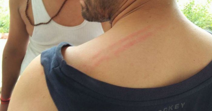 लाठीचार्ज की चोट दिखाता एक छात्र.