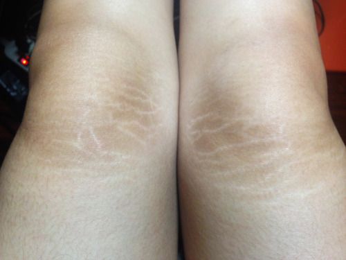 घुटनों पर बने स्ट्रेच मार्क्स. फोटो क्रेडिटः टंबलर