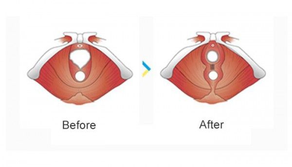 हाइमनोप्लास्टी के पहले और बाद में वजाइना की तस्वीर. (तस्वीर साभार: Manhattan Centre for Vaginal Surgery)