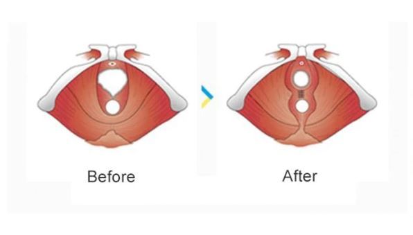 Hymenoplasty Manhattan Centre