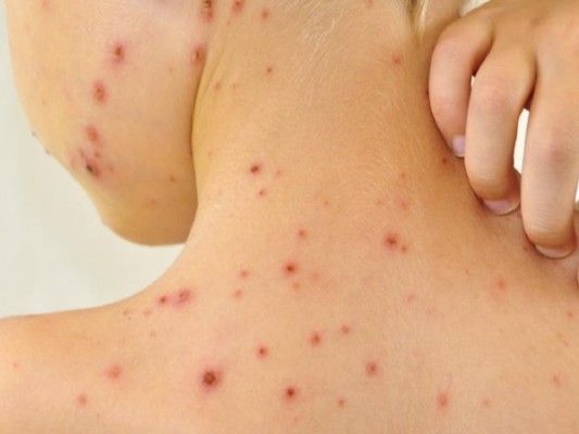 चिकन पॉक्स के 90 प्रतिशत केसेज़ 10 साल से कम उम्र के बच्चों में होते हैं