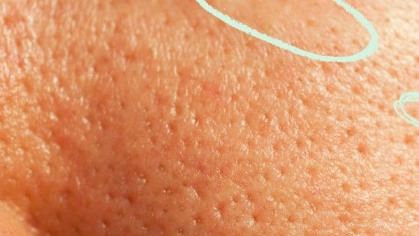 ओपन पोर्स को समेटकर रखने वाली इलास्टिकनुमा स्किन (इलास्टिन) ढीली पड़ने लगती है और ये पोर्स खुल जाते हैं