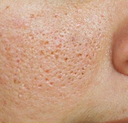 ओपन पोर्स सबके होते हैं पर समय के साथ ये ओपन पोर्स ज़्यादा दिखाई देने लगते हैं