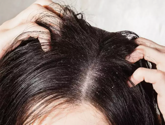 ऑयली स्केल्प की वजह से बाल नज़र आने लगते हैं एकदम फ्लैट- Freepik Oily Scalp