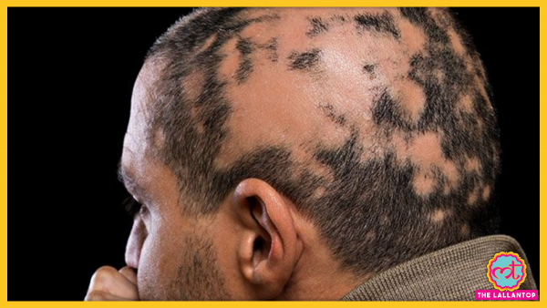 Hair loss (alopecia) 